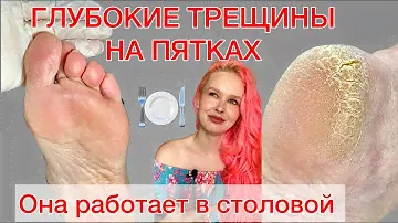 ОНИХОЛИЗИС | ТРЕЩИНЫ НА ПЯТКАХ | СТЕРЖНЕВАЯ МОЗОЛЬ | АНАЛИЗ ОБУВИ #алена_лаврентьева #подолог