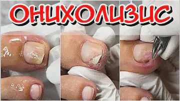 ОНихолизис / Зачистка / Зачистка Онихолизиса / Скрученный ноготь / Болит ноготь что делать?
